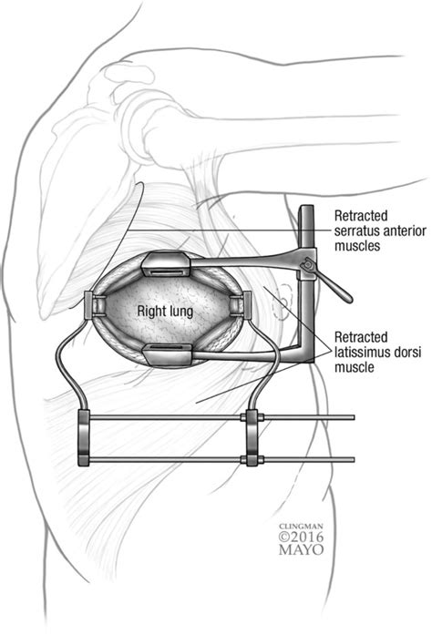 Muscle Sparing Thoracotomy Operative Techniques In Thoracic And