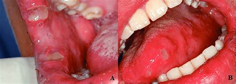 A Ulcers In The Labial Mucosa Of The Right Corner Of Mouth B Two