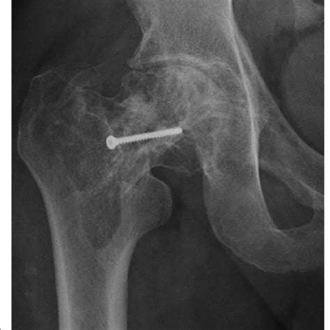 Ap Radiograph Of The Right Hip Showing A Basicervical Femoral Fracture
