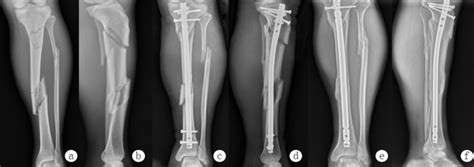 A Case Of A Two Segmental Fracture Of The Left Tibia Aoasif Type