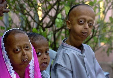 Progeria Studies Shed Light On Rare Premature Aging Disorder Huffpost