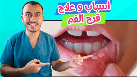 التهاب الفم او قرح الفم و تقرحات الفم اسبابها و علاج التهاب الفم Youtube