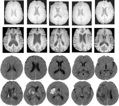 Examples Of Normal And Abnormal Images Brain Mri Images In The