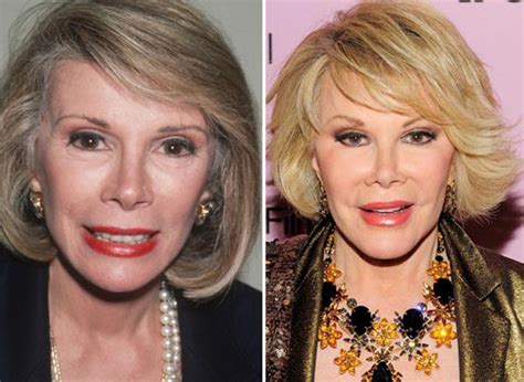 Joan Rivers Facelift Plastic Surgery Before And After Celebie