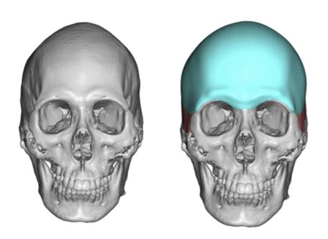 Custom Forehead Implants Eppley Custom Facial Implants