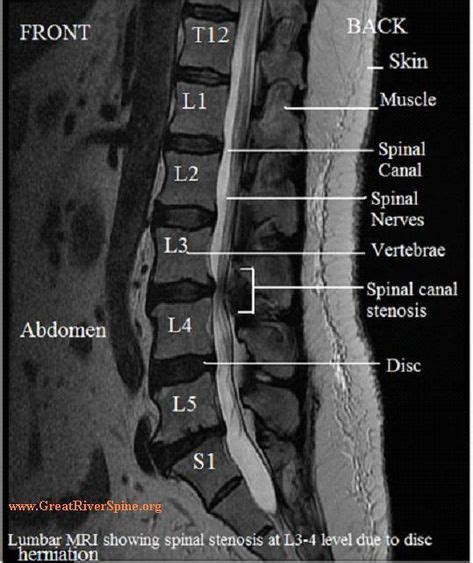 Lumbar Spine Mri Lumbar Spinal Stenosis Mri Spinal Stenosis Lumbar