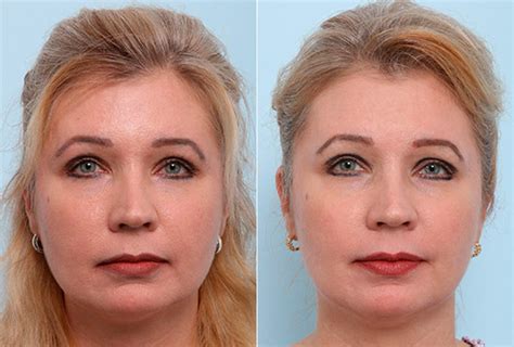 Buccal Fat Pad Removal Photos Houston Tx Patient 27796