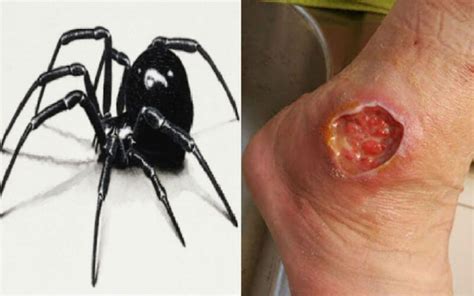 Black Widow Bite Causes Symptoms Treatments And Important Details