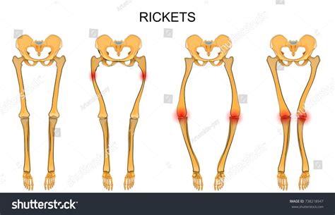 Rickets Over 276 Royalty Free Licensable Stock Vectors And Vector Art
