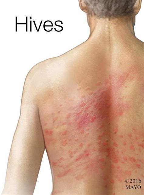 Mayo Clinic Q And A Chronic Hives Come And Go With No Clear Pattern
