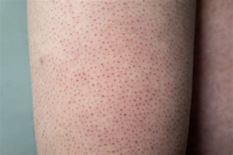 Strawberry Legs Causes And How To Get Rid Of Them Watsons Philippines