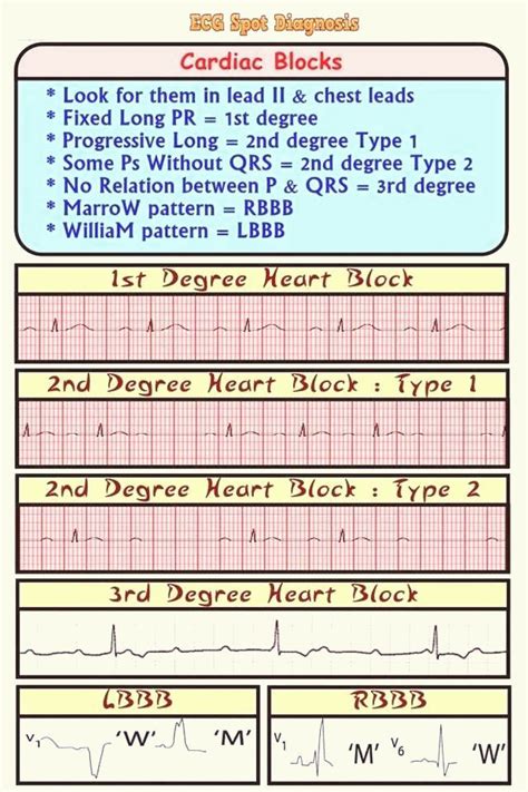 Ecgekg Spot Diagnosis Cardiac Rhythms Heart Blocks Cardiac Ecg Rhythm