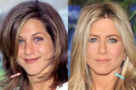 Has Jennifer Aniston Had Plastic Surgery Before And After