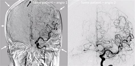 The Art Of Cerebral Angiography Neuroangio Org