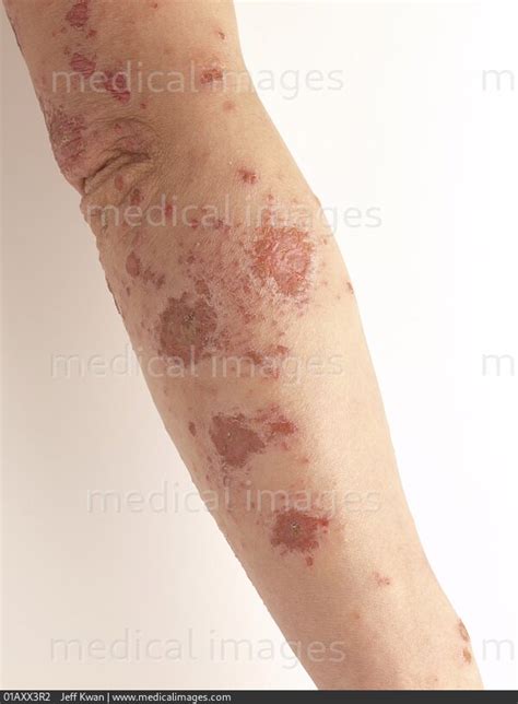 Stock Image Spongiotic Dermatitis Eczema Female Patient 195912