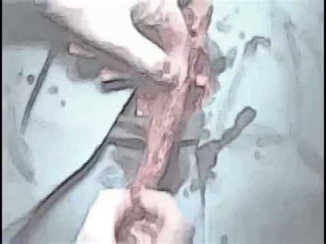 Vaginoplasty Transsexual Surgery Remix Youtube