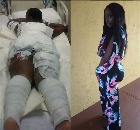 Months After Suffering From Fire Burns See What This Lady Looks Like