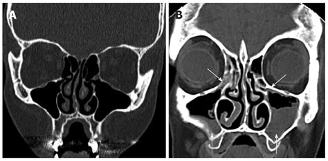 Computed Tomography Scans Of Paranasal Sinuses Before Functional