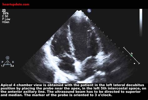 Echocardiography Apical 4 Chamber View Ap4ch Sonographer Cardiac