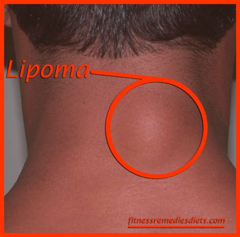 What Is A Lipoma Lipoma Treatment How To Remove A Lipoma Health