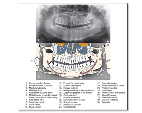 Dentaltown Anatomical Landmarks On A Panoramic Radiograph Dental My