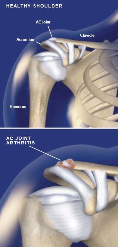 What Is Acromioclavicular Arthritis Ac Joint Arthritis My Xxx Hot Girl