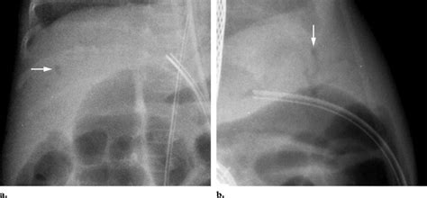 Radiographic And Sonographic Appearances Of Portal Venous Gas A