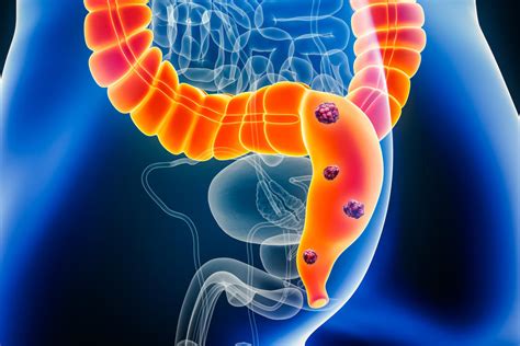 Avastin And Lonsurf For Advanced Colorectal Cancer Nci