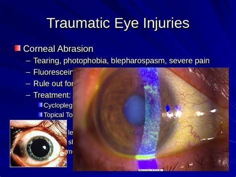 Traumatic Eye Injuries By Barakzay Dastagir Traumatic