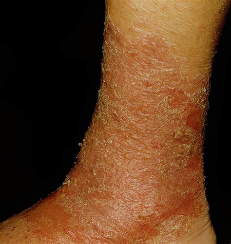 Stasis Dermatitis Histology