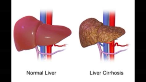 Enlarged Liver Causes Symptoms And Treatment Youtube