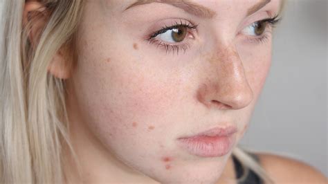 What You Are Doing That May Be Causing Acne Northwest Aesthetics