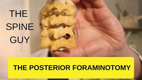 Cervical Stenosis Radiculopathy Part The Posterior Foraminotomy Youtube