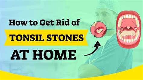 Remove Tonsil Stones At Home Fast Without Any Surgery 12 Powerful