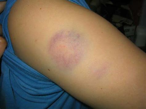 How To Heal Paintball Bruises Paintball Bruises