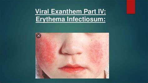 Erythema Infectiosum Made Very Simple