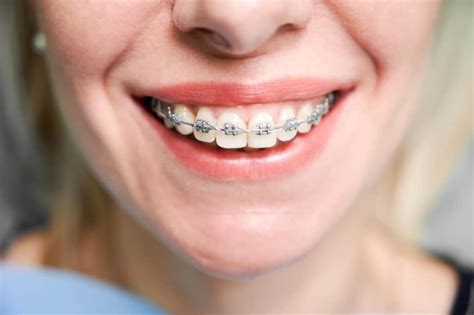 When Can I Get Adult Braces Wired Orthodontics