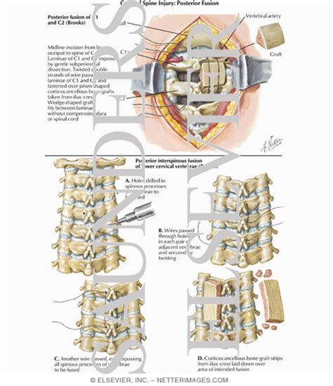 Cervical Spine Injury Posterior Fusion