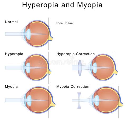 Myopia And Hyperopia Stock Vector Image 40924891