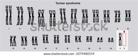 Human Karyotype Turner Syndrome One X Stock Vector Royalty Free
