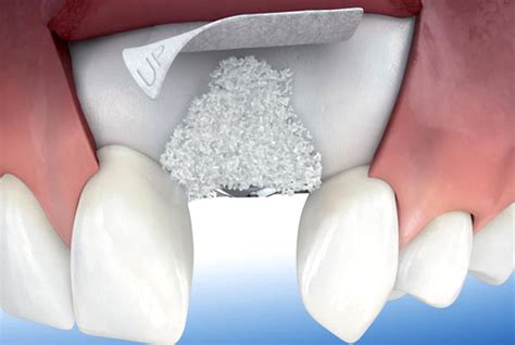 Injerto de hueso dental Qué es y cuándo se utiliza