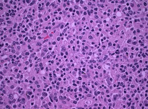 Pathology Outlines T Cell Histiocyte Rich Diffuse Large B Cell Lymphoma