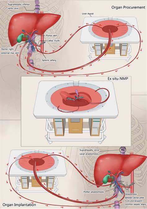 Ischaemia Free Liver Transplantation In Humans A First In Human Trial