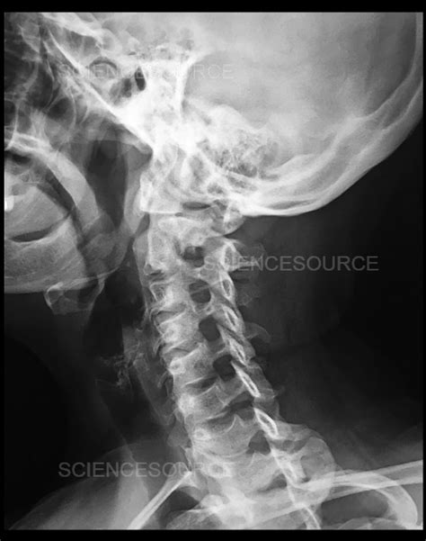 Normal Cervical Spine X Ray Stock Image Science Source Images