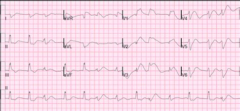 Usually preceded by physiological deterioration but can occur in previously stable patients. Dr. Smith's ECG Blog: Cardiac arrest, severe acidosis, and ...