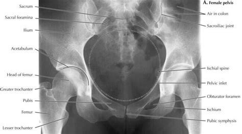 The female bony pelvis is divided into: Female pelvis X-ray diagram