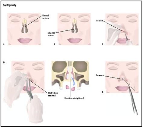 The Different Surgical Treatments For A Deviated Septum Deviated Septum Information Advice