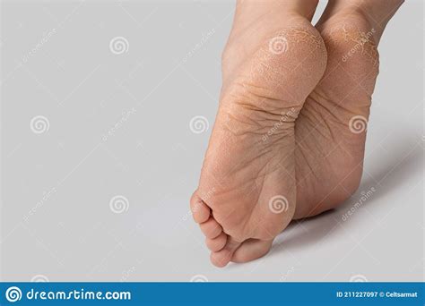 Rough Skin On Female Feet On Grey Background Dry And Cracked Soles Of