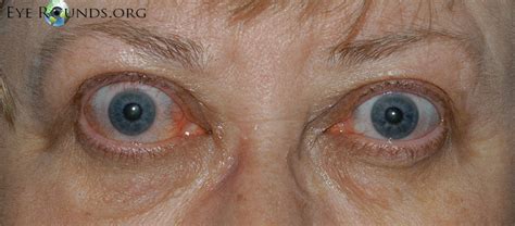 Thyroid Eye Disesase Patient Information