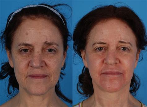 Before And After Photos Jefferson Facial Plastics